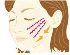 面部埋線提升示意圖