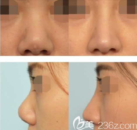 張衍爐隆鼻真人案例 張衍爐隆鼻真人案例