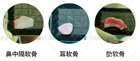 鼻綜合中常用到的自體軟骨材料分為：鼻中隔軟骨、耳軟骨、肋軟骨