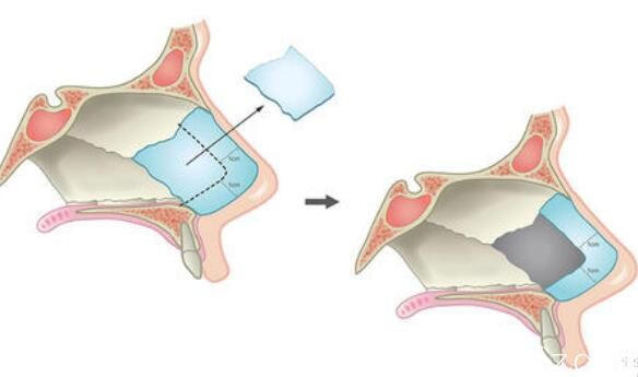 一定范圍內取鼻中隔軟骨后鼻子不會塌陷