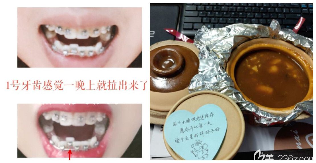 在看過(guò)小表妹在寧波恒美口腔矯正齙牙的效果后，我也慕名來(lái)找王金主任做正畸了