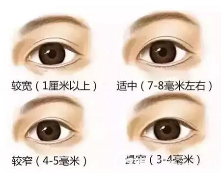 割雙眼皮適合寬度介紹