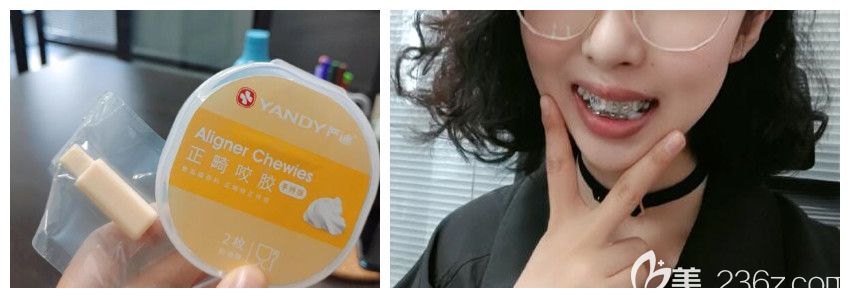 戴鋼絲牙套矯正齙牙第5天 戴鋼絲牙套矯正齙牙第5天