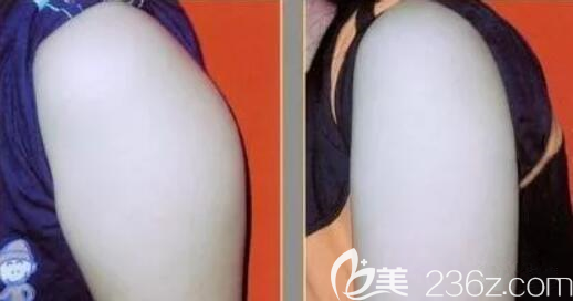 蝴蝶袖術(shù)后效果對(duì)比