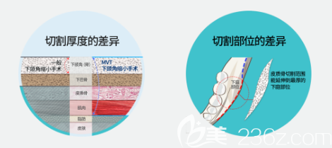 廣州韓妃整形醫(yī)院柳超磨骨優(yōu)勢