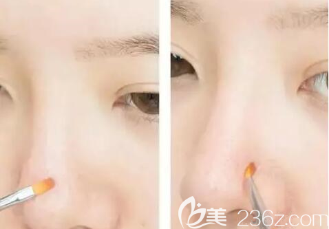 毛孔粗大小妙招 毛孔粗大小妙招