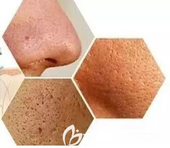 毛孔粗大像蜂窩煤一樣 毛孔粗大像蜂窩煤一樣