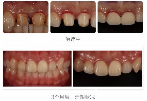 徐路路門牙全瓷冠失敗修復(fù)案例前后效果對比圖