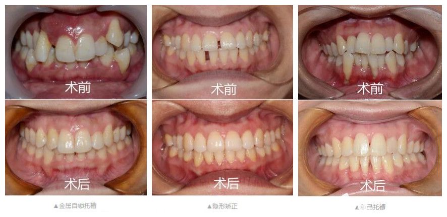 金屬托槽矯正虎牙+隱形矯正牙縫稀疏+自鎖托槽矯正擁擠不齊牙齒