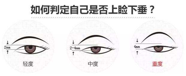 看看你是不是上瞼下垂