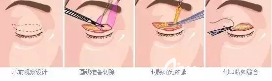 上瞼提肌縮短手術(shù)