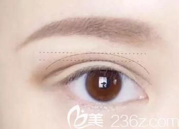 雙眼皮后出現(xiàn)疤痕增生該怎么辦？