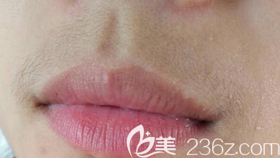 唇毛讓女性充滿男性化