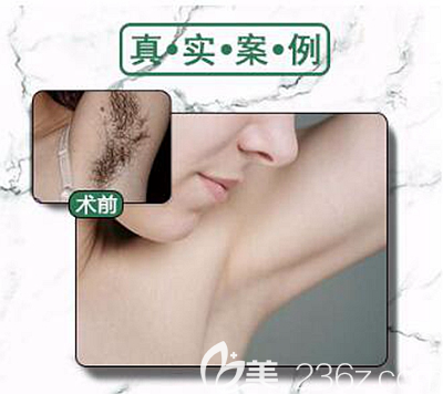 信陽東方藝冰點激光脫毛案例