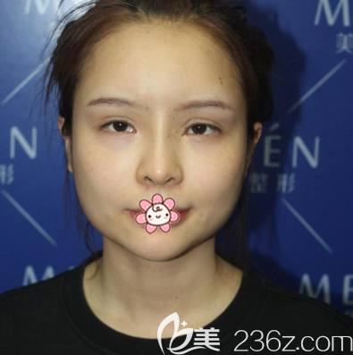 在廣州美恩做下頜角術(shù)前照片 在廣州美恩做下頜角術(shù)前照片