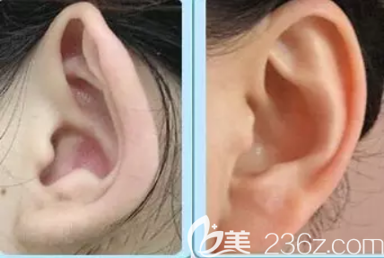 招風耳矯正后效果對比