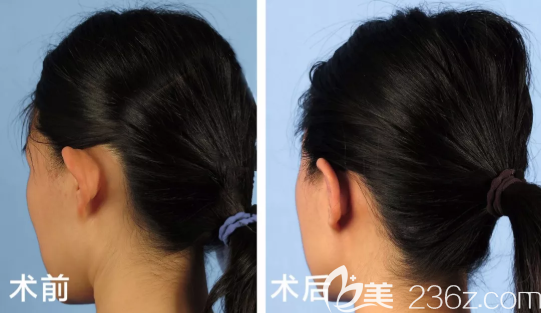 招風耳矯正案例