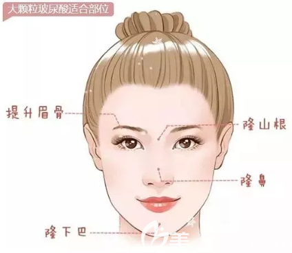 大分子玻尿酸填充部位