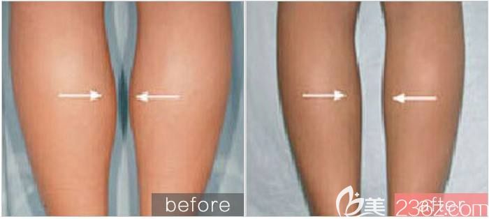 注射蘭州瘦腿對比案例