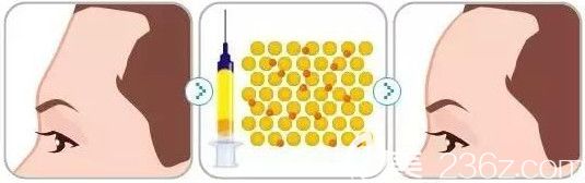 自體脂肪填充額頭手術(shù)效果