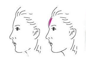 額頭飽滿和不飽滿的對比