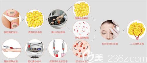 做自體脂肪填充額頭過程