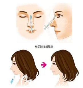 玻尿酸隆鼻示意圖