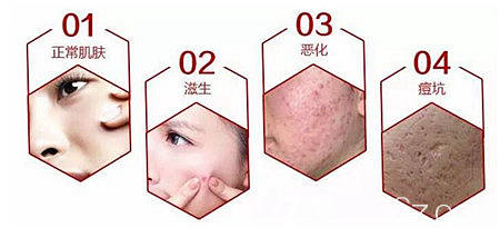 痘坑痘印是如何產(chǎn)生的