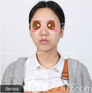 <!--<i data=20240703-sp></i>-->時光何晉龍鼻綜合真人案例術(shù)前照 <!--<i data=20240703-sp></i>-->時光何晉龍鼻綜合真人案例術(shù)前照