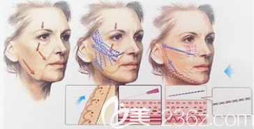 埋線提升手術(shù)過程圖