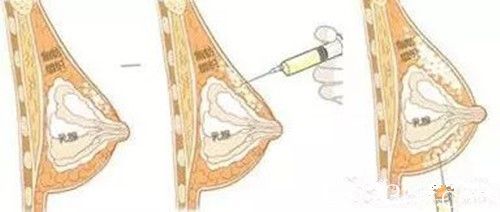 自體脂肪分層次注射提高成活率