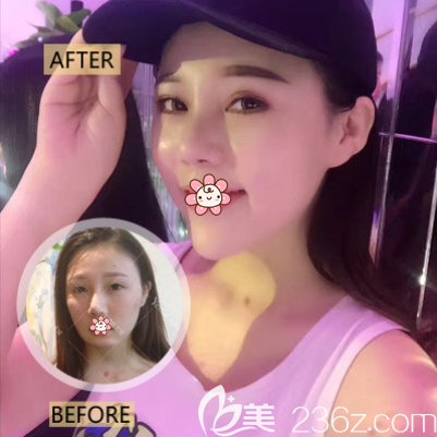 重慶藝星整形朱家旭墊下巴效果