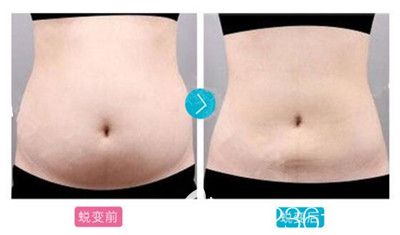 駐馬店締萊美分層腰腹吸脂案例