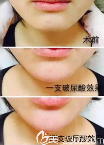 一支玻尿酸和兩支效果對(duì)比