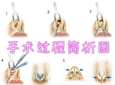 隆鼻手術(shù)過程簡析圖
