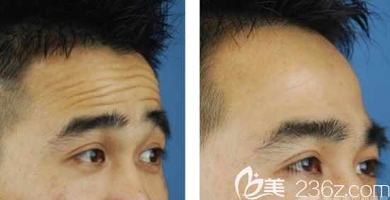 注射包尿酸去除抬頭紋效果