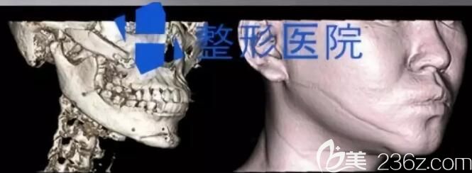 韓國(guó)H整形醫(yī)院下頜角修復(fù)術(shù)前CT圖片 韓國(guó)H整形醫(yī)院下頜角修復(fù)術(shù)前CT圖片