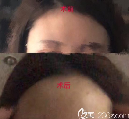 韓國(guó)boneps骨水泥填充額頭價(jià)格2.2萬(wàn)多總體符合我的要求