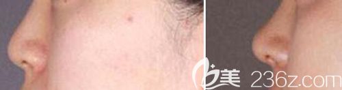 鼻小柱延長術(shù)前術(shù)后效果對(duì)比