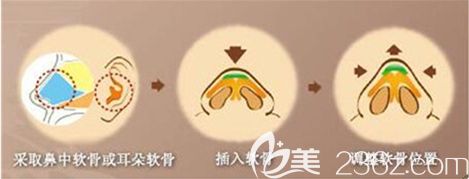 墊鼻尖整形手術(shù)步驟簡易圖