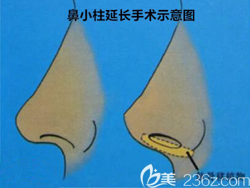 做鼻小柱延長手術(shù)步驟示意圖