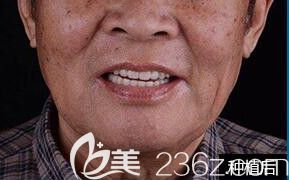 北京瑞鯊口腔花1個(gè)半小時(shí)為朱老伯種植了11顆牙，術(shù)后為試種牙效果他竟當(dāng)場(chǎng)啃排骨