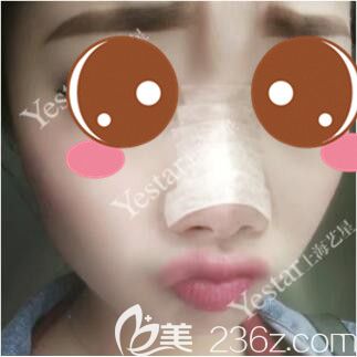 <!--<i data=20240703-sp></i>-->藝星傅金萍鼻綜合真人案例術(shù)后第5天