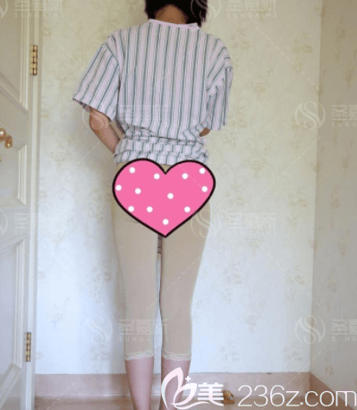 楊佳琦醫(yī)生給我做腿部吸脂第3天樣子 楊佳琦醫(yī)生給我做腿部吸脂第3天樣子