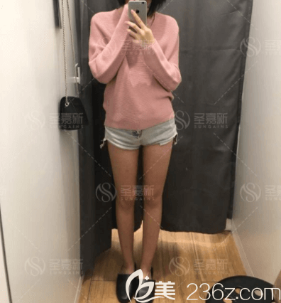 我在北京圣嘉新做腿部吸脂一個月效果 我在北京圣嘉新做腿部吸脂一個月效果