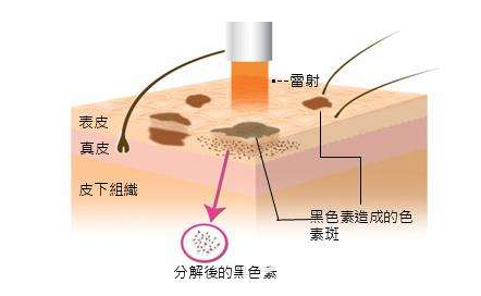 激光祛斑原理示意圖