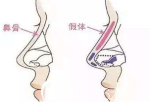 假體隆鼻 假體隆鼻