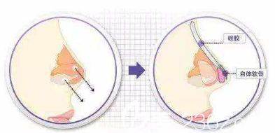 假體隆鼻手術(shù)示意圖 假體隆鼻手術(shù)示意圖
