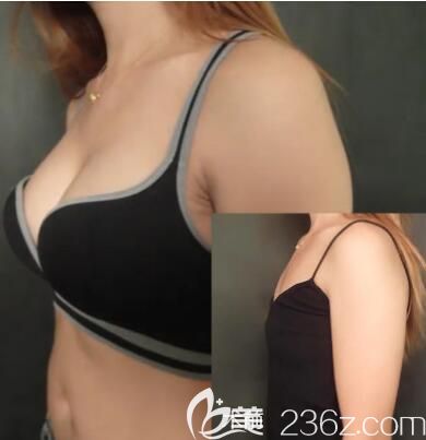 洛陽華美田會建院長自體脂肪豐胸