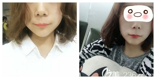 冷門整形項(xiàng)目貼：厚唇改薄+微笑唇蛻變，南京這家醫(yī)院分享的還有詳細(xì)術(shù)后護(hù)理攻略